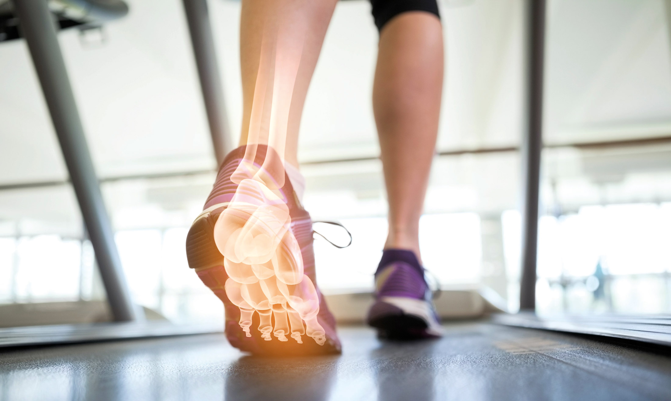 Läufer auf Laufband mit eingeblendeter Röntgendarstellung des Fußes als Symbol für orthopädische Diagnostik und Bewegungsanalyse.