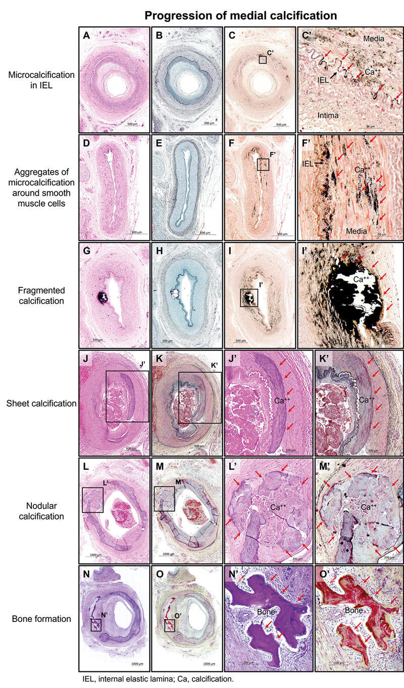 Histologische Darstellung der Mediasklerose: Stadien medialer Gefäßverkalkung von Mikrocalcifikation bis Knochenbildung.