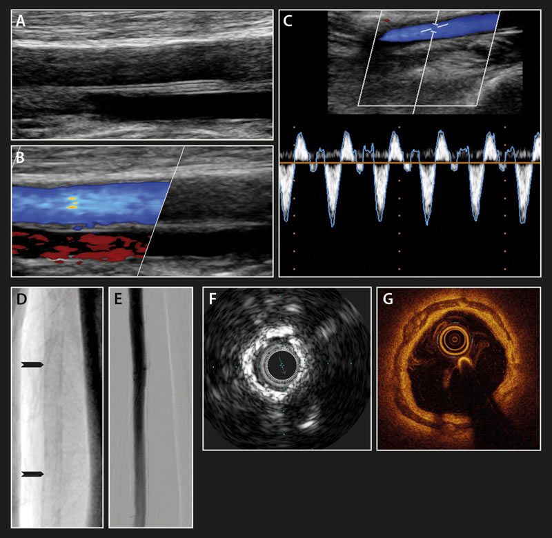 Bildgebende Diagnostik der Mediasklerose: Ultraschall, CT, intravaskulärer Ultraschall und optische Kohärenztomographie im Vergleich.