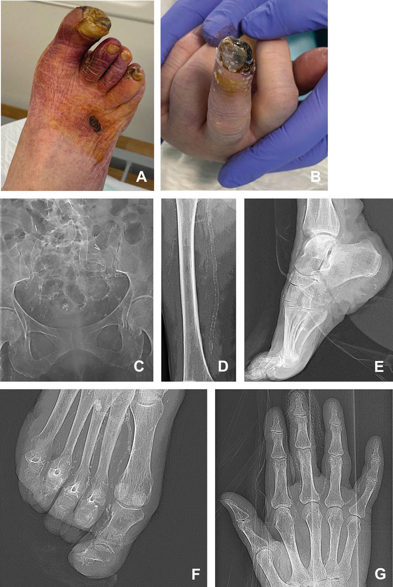 Fortgeschrittene Mediasklerose: Nekrosen an Fuß und Hand mit Röntgenbildern zur Gefäßverkalkung in unteren und oberen Extremitäten.