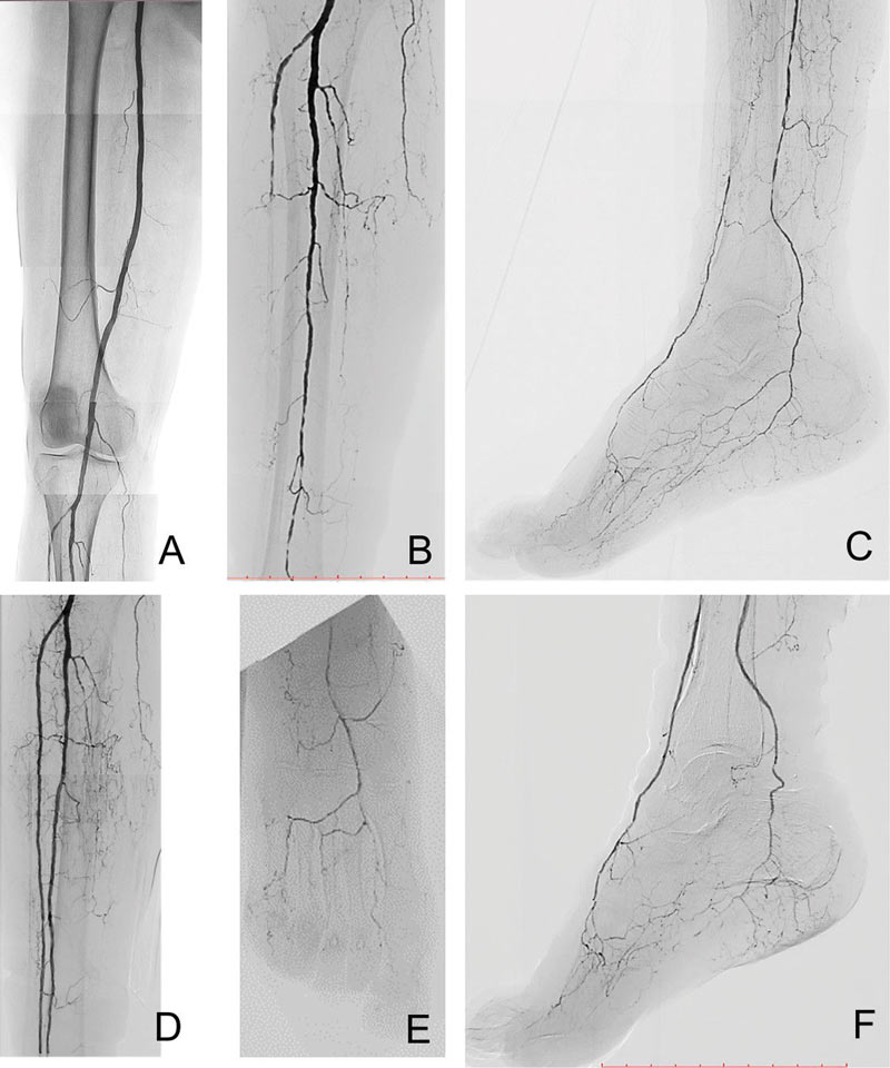 Angiografie der Bein- und Fußarterien: Darstellung von Durchblutungsstörungen und Gefäßverschlüssen bei peripherer arterieller Erkrankung.