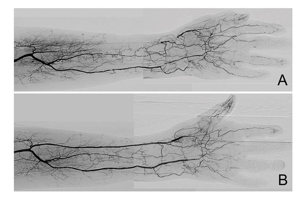 Angiografie der Handarterien: Vergleich von Gefäßdarstellungen zur Erkennung von Durchblutungsstörungen und arteriellen Verschlüssen.