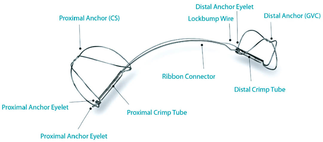 Schematische Darstellung des Carillon®-Systems mit proximalen und distalen Ankern, Drahtverbindung und Fixierungselementen.