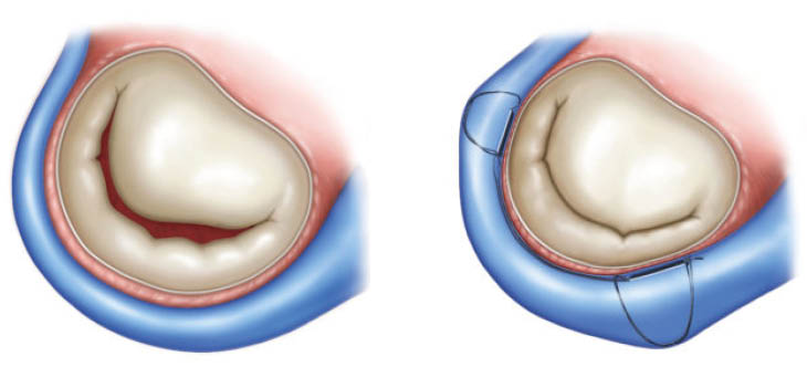 Medizinische Illustration einer Mitralklappeninsuffizienz vor und nach interventioneller Behandlung zur Klappenrekonstruktion.