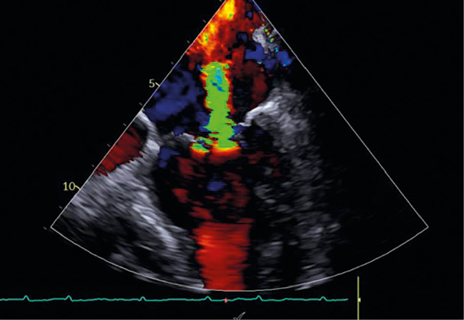 Mitralklappeninsuffizienz in TEE vor der Behandlung