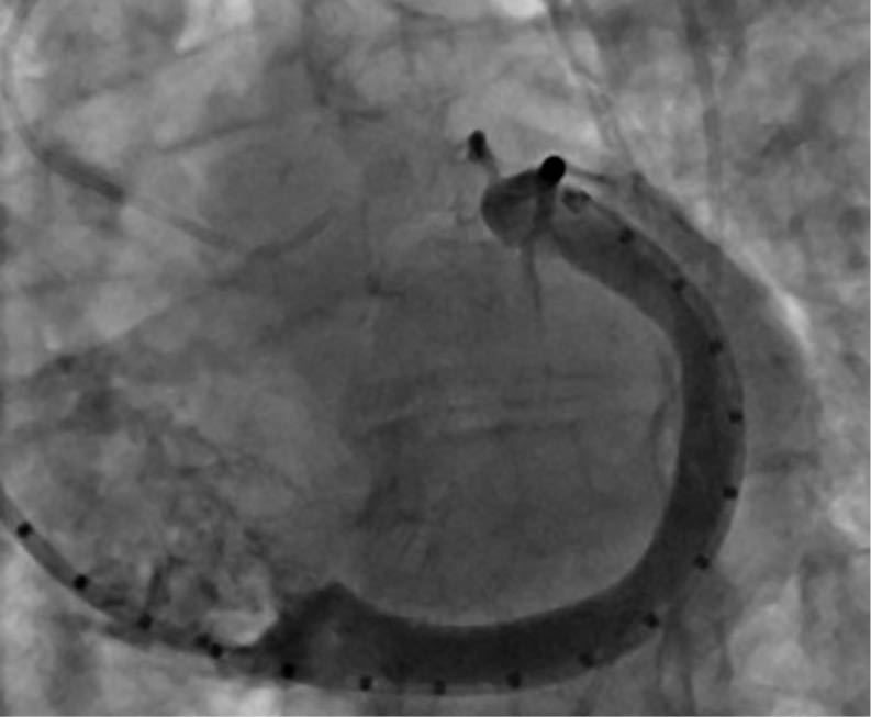 Intraprozedurales Sizing unter Fluoroskopie während eines interventionellen kardialen Eingriffs zur Anpassung eines Implantats.