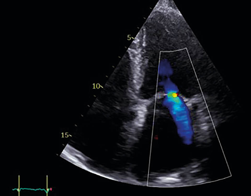 Mitralklappeninsuffizienz in TTE nach der Behandlung