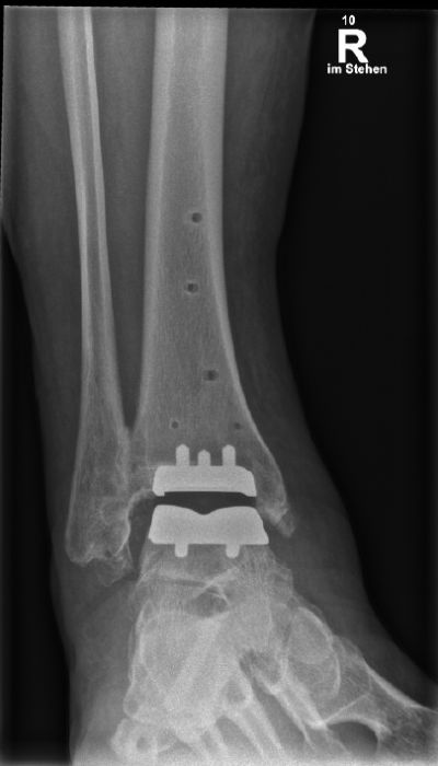 Röntgenaufnahme des rechten Sprunggelenks mit eingesetzter Prothese im Stand zur postoperativen Kontrolle.