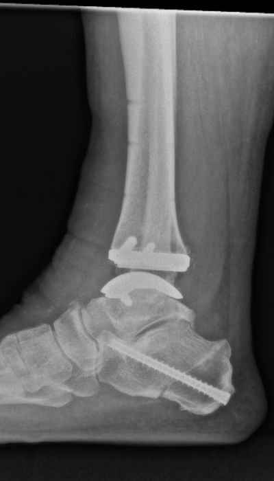 Seitliche Röntgenaufnahme des rechten Sprunggelenks mit eingesetzter Prothese und Fixierungsschraube im Fersenbein.