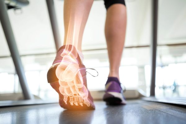 Läufer auf Laufband mit eingeblendeter Röntgendarstellung des Fußes als Symbol für orthopädische Diagnostik und Bewegungsanalyse.