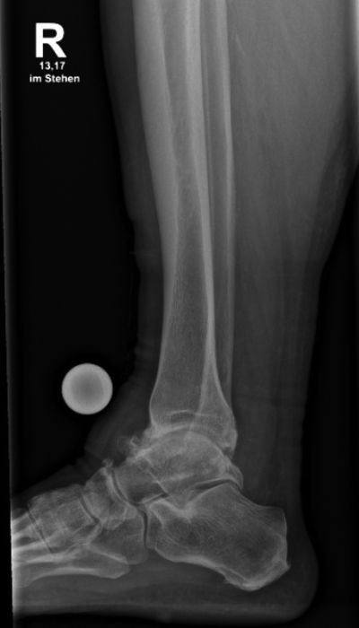 Röntgenaufnahme des rechten Sprunggelenks im seitlichen Standbild zur medizinischen Untersuchung.