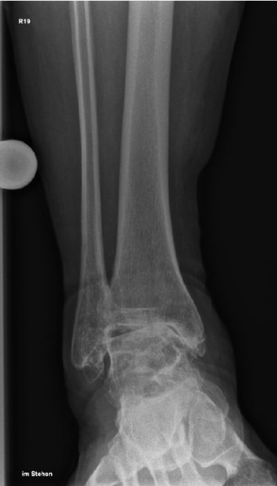 Röntgenaufnahme eines rechten Sprunggelenks mit Unterschenkelknochen zur medizinischen Diagnostik.