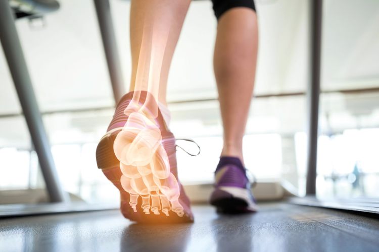 „Läufer auf Laufband mit eingeblendeter Röntgendarstellung des Fußes als Symbol für orthopädische Diagnostik und Bewegungsanalyse.