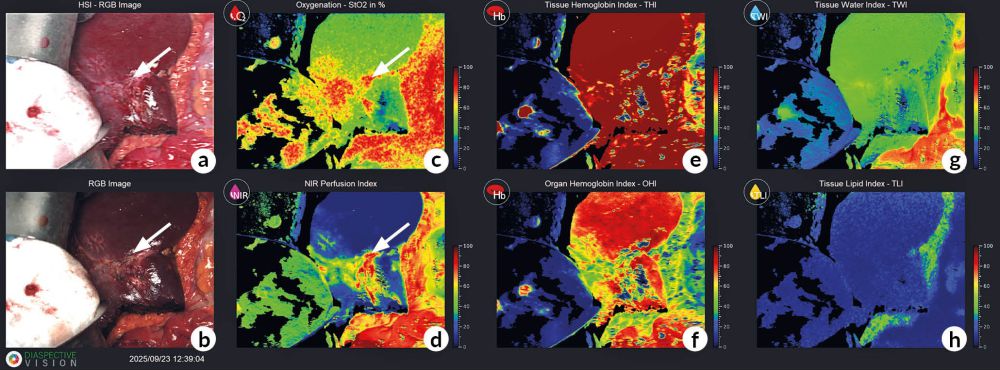Hyperspektral-Imaging zeigt Gewebeperfusion, Sauerstoffsättigung und Hämoglobinindex im OP