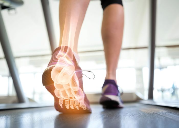 Läufer auf Laufband mit eingeblendeter Röntgendarstellung des Fußes als Symbol für orthopädische Diagnostik und Bewegungsanalyse.