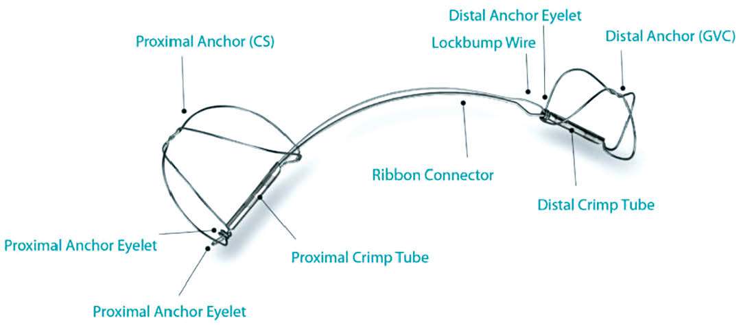 Schematische Darstellung des Carillon®-Systems mit proximalen und distalen Ankern, Drahtverbindung und Fixierungselementen.