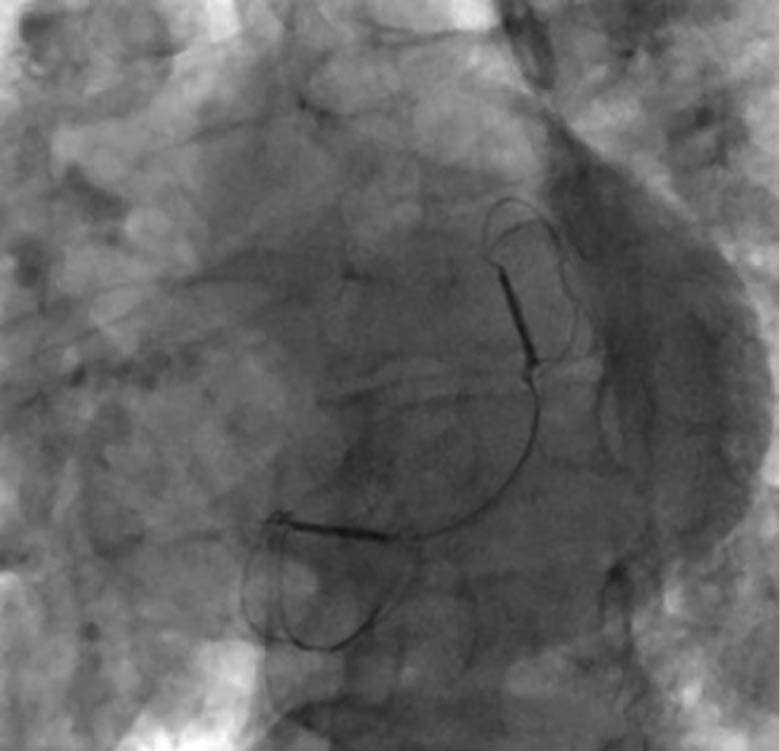 Fluoroskopische Darstellung des Endergebnisses nach Implantation des CARILLON®-Systems bei Mitralklappeninsuffizienz.