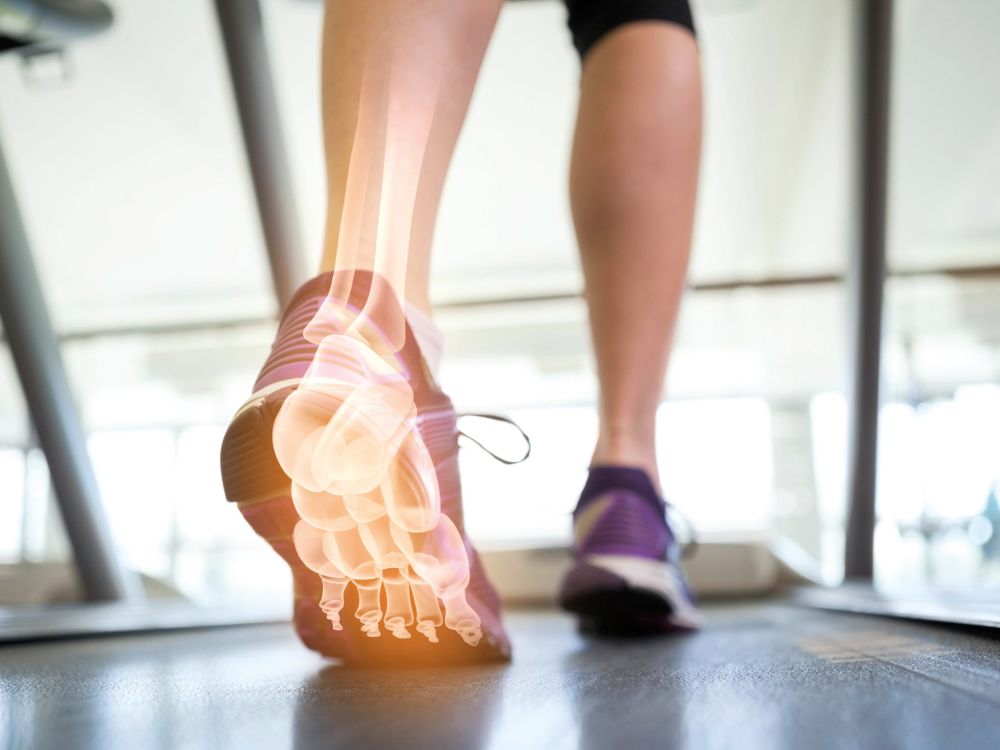 Läufer auf Laufband mit eingeblendeter Röntgendarstellung des Fußes als Symbol für orthopädische Diagnostik und Bewegungsanalyse.
