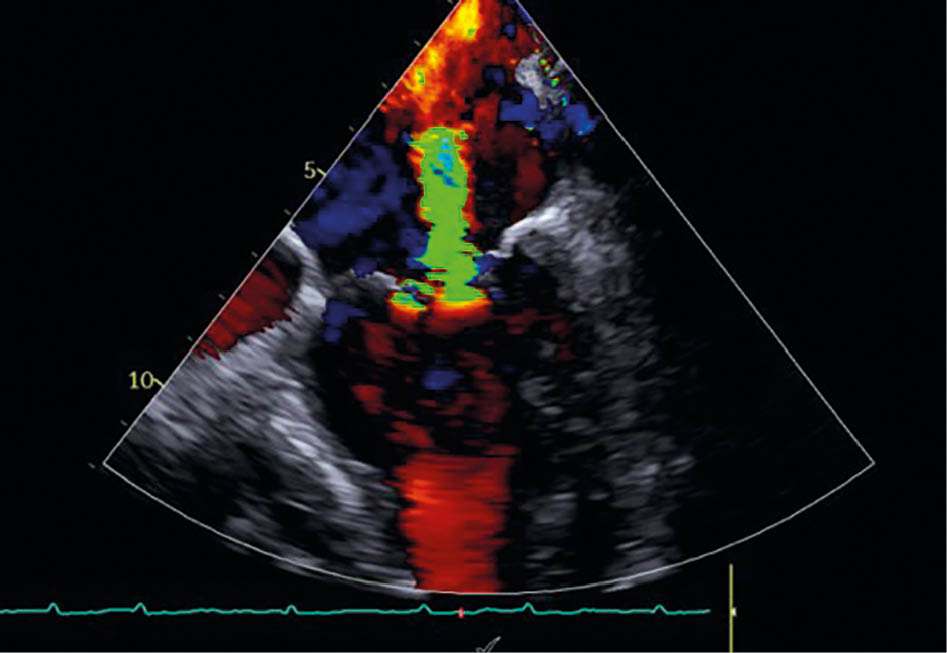 Mitralklappeninsuffizienz in TEE vor der Behandlung