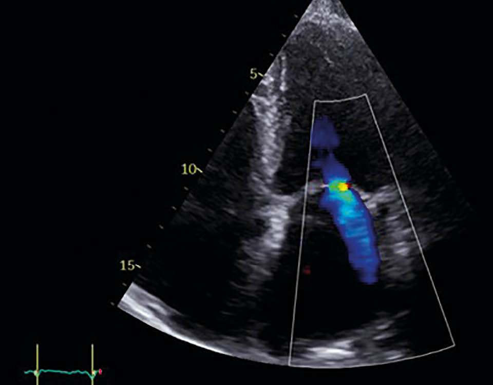 Mitralklappeninsuffizienz in TTE nach der Behandlung