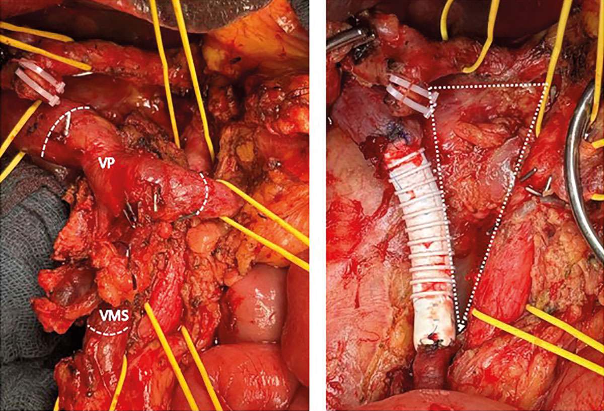 Intraoperative Darstellung einer TRIANGLE-Operation mit Ersatz und Rekonstruktion der Pfortader und V. mesenterica superior.