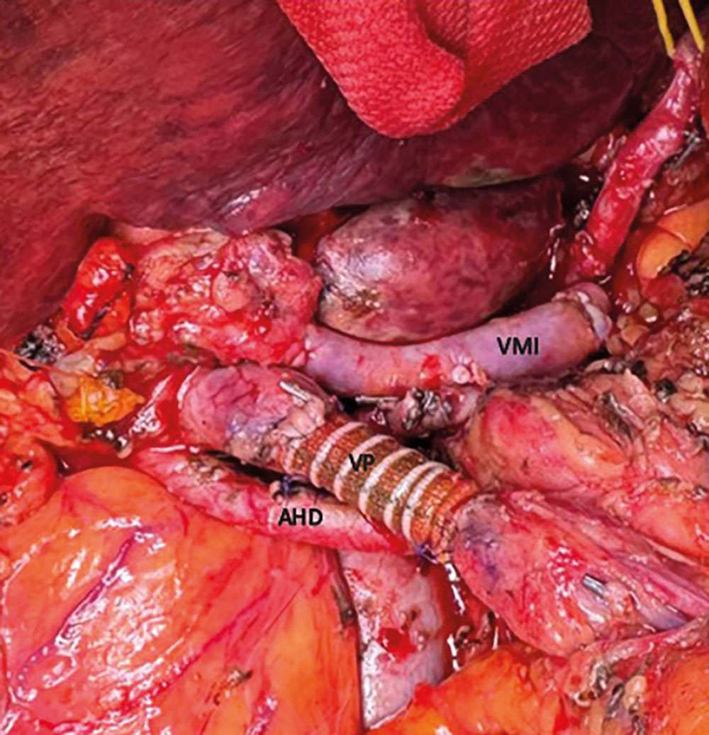 Intraoperative Aufnahme der Pankreaschirurgie mit markierten Blutgefäßen und rekonstruiertem Gefäßsegment.